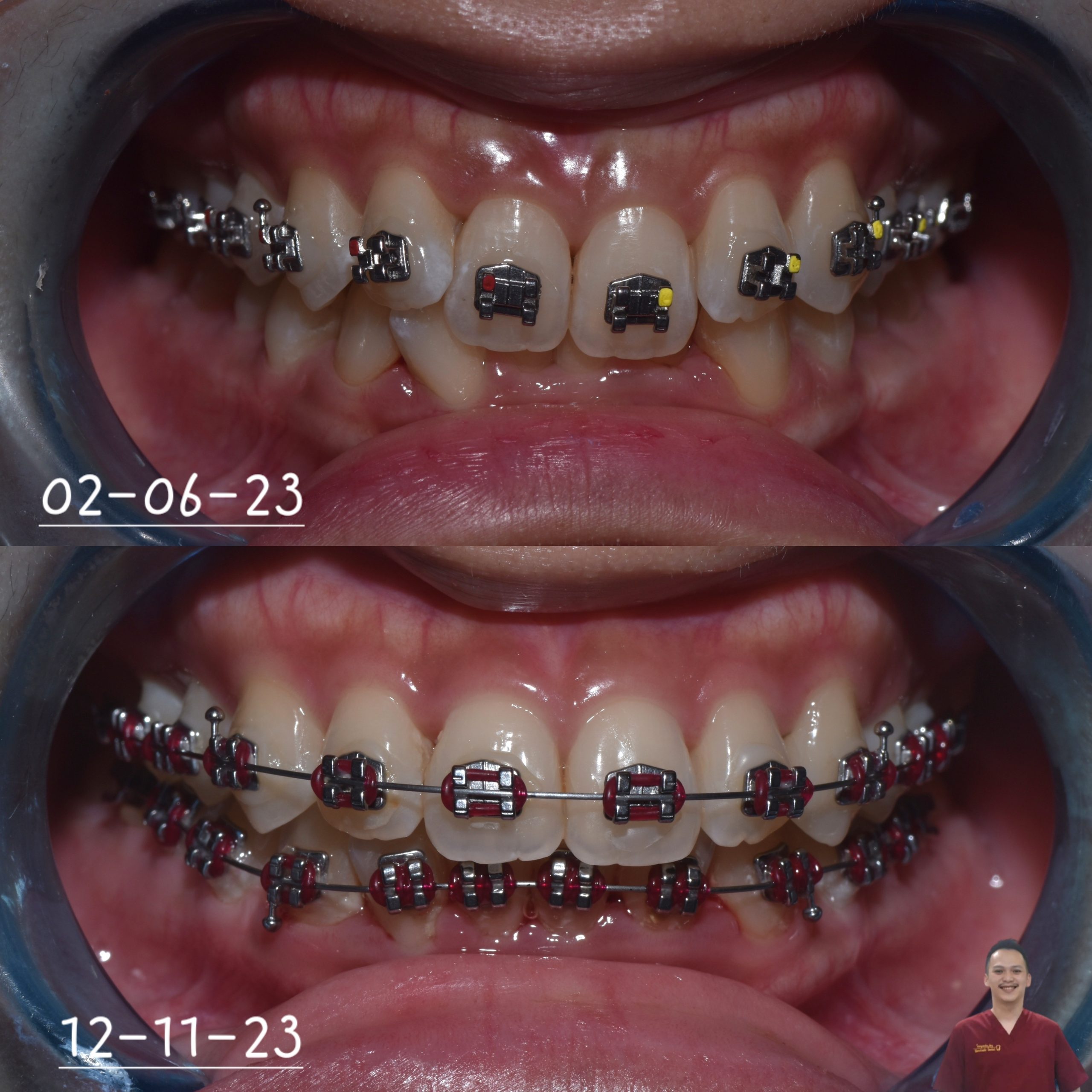 before after behel / kawat gigi